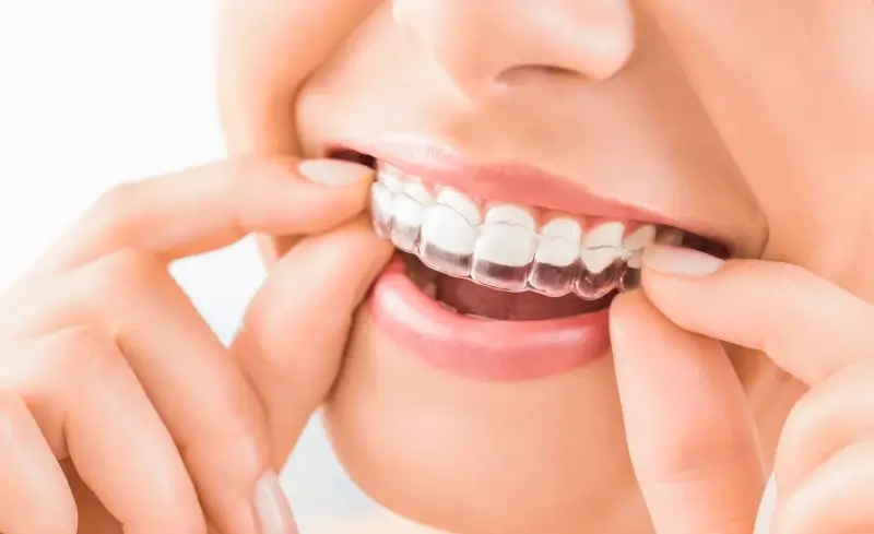 dlaczego-warto-wybrac-leczenie-invisalign-1