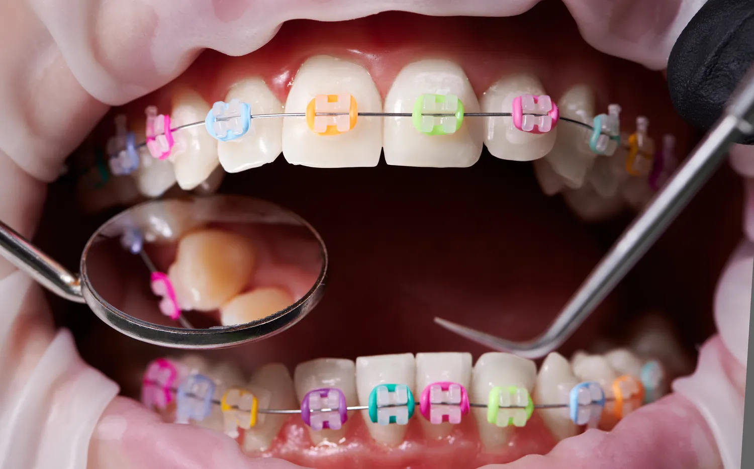 Stomatolog wykona odbudowę uzębienia przy pomocy implantów zębowych