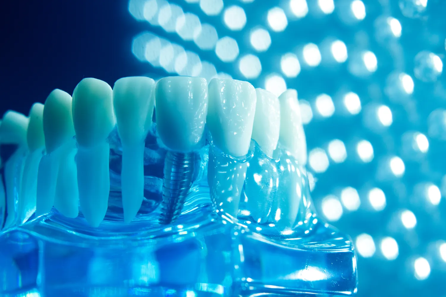 implanty-koszt-warszawa-1