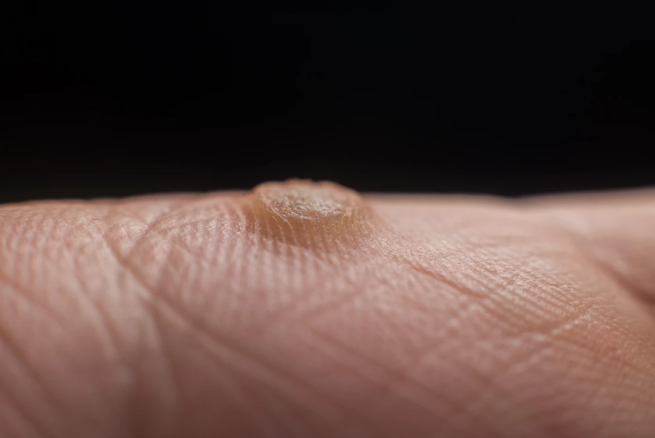 co-najlepiej-stosowac-na-kurzajki-1