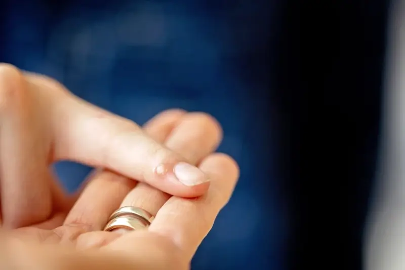 jak-chirurg-usuwa-kurzajki-f